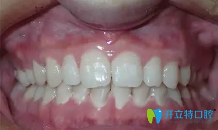 廈門康德佳口腔牙齒矯正術(shù)后照