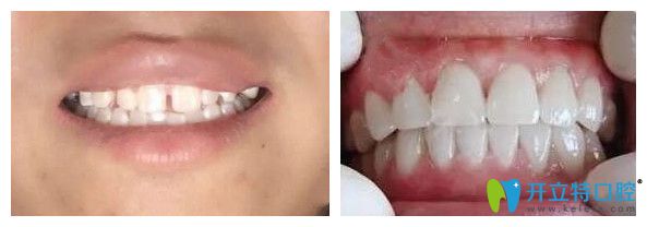 重慶鵬博口腔何冰華醫(yī)生前牙貼面效果圖 重慶鵬博口腔何冰華醫(yī)生前牙貼面效果圖