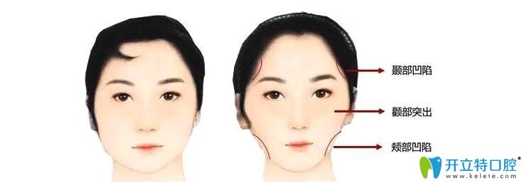 想知道如何避免牙套臉，就得清楚牙套臉是什么