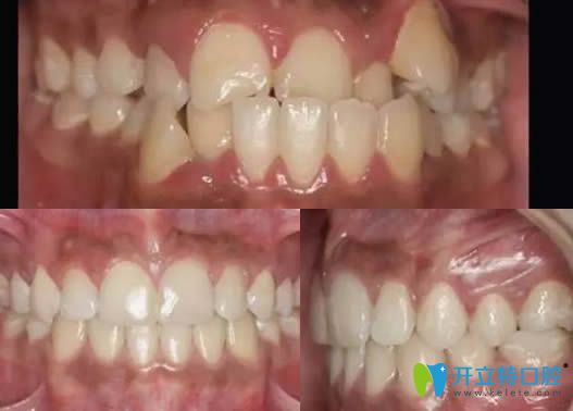 安徽維多利亞口腔陳婷婷醫(yī)生正畸案例效果圖 安徽維多利亞口腔陳婷婷醫(yī)生正畸案例效果圖