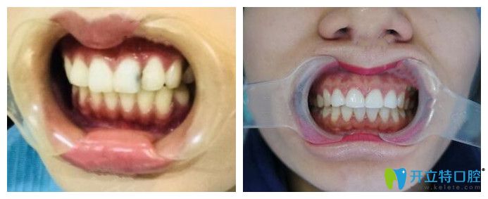 重慶鵬博口腔張權(quán)智醫(yī)生前牙貼面案例