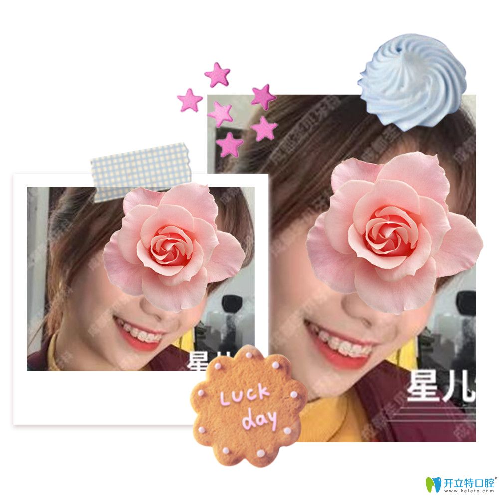 屬于成都圣貝口腔半隱形陶瓷矯正案例 屬于成都圣貝口腔半隱形陶瓷矯正案例