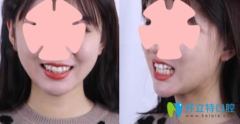 發(fā)一篇在安徽維多利亞口腔歷時(shí)一年半的隱適美正畸效果