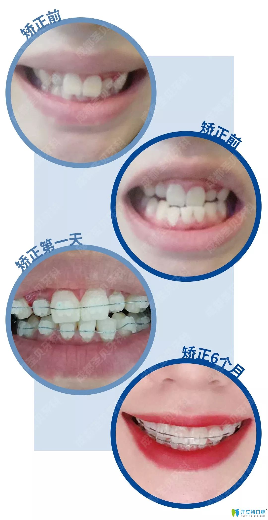 圣貝牙科牙齒不齊矯正1-6個(gè)月變化過程照片 圣貝牙科牙齒不齊矯正1-6個(gè)月變化過程照片