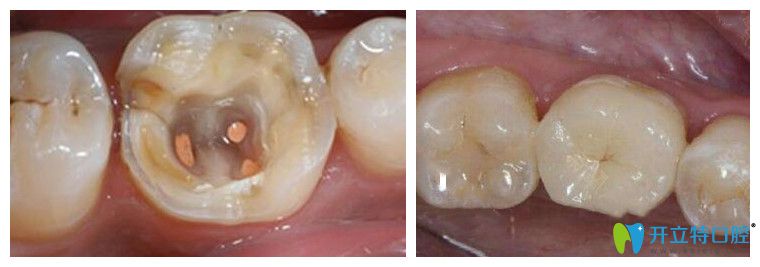 泰州北極星口腔竇鹿鳴醫(yī)生后牙根管治療案例 泰州北極星口腔竇鹿鳴醫(yī)生后牙根管治療案例