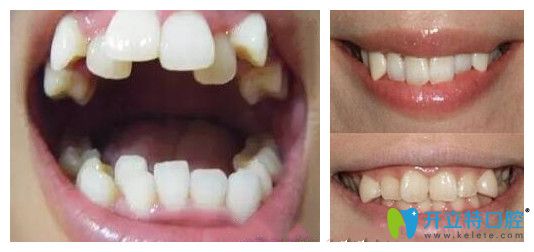 談?wù)劙酥佚X是什么意思以及虎牙和八重牙有區(qū)別嗎？