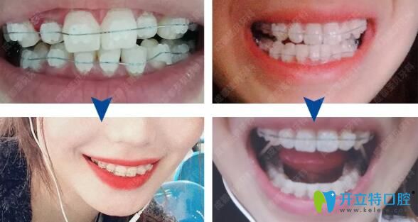 半隱形矯正效果很明顯 半隱形矯正效果很明顯