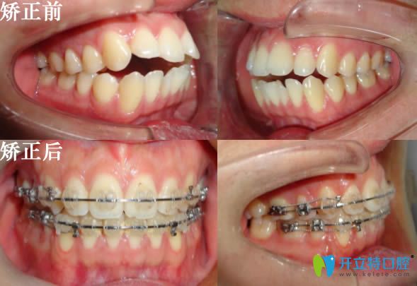 沈陽歡樂肖春主任兒童牙齒開合矯正對(duì)比效果