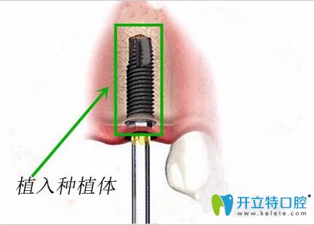 種植牙過程第3步圖解