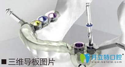 數(shù)字化3D導(dǎo)板種植技術(shù)