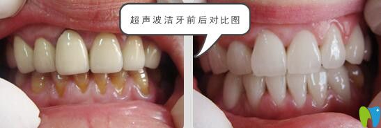 超聲波潔牙前后對(duì)比圖