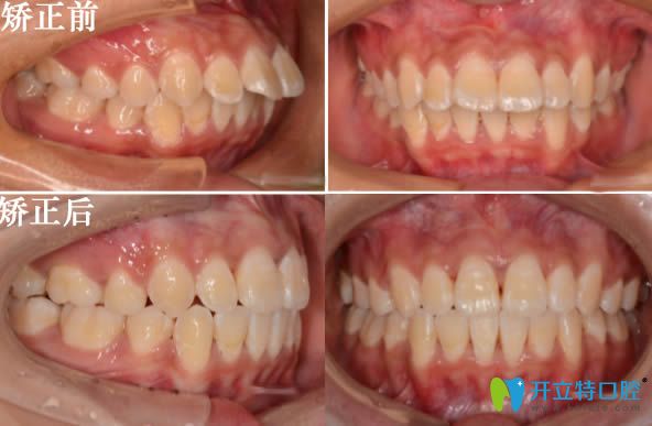 沈陽歡樂口腔肖春醫(yī)生成人深覆蓋矯正前后對(duì)比照