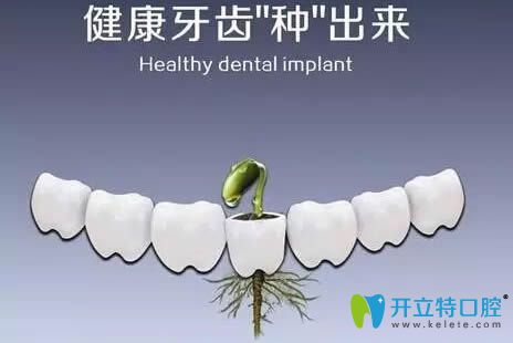 種植牙宣傳圖