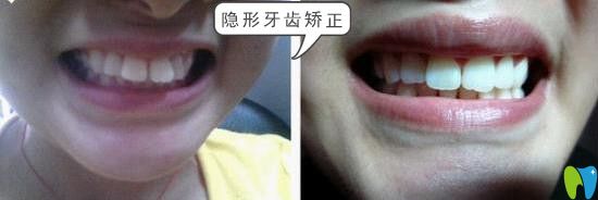 鵬博口腔門牙突出隱形矯正效果