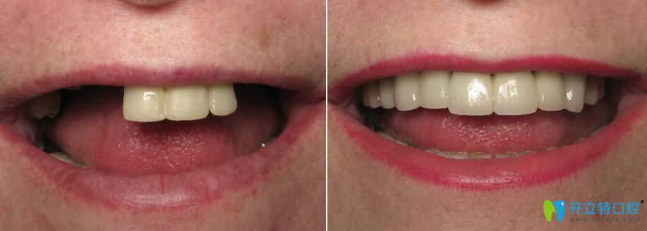 松桃鵬博口腔微創(chuàng)種植牙前后對比效果