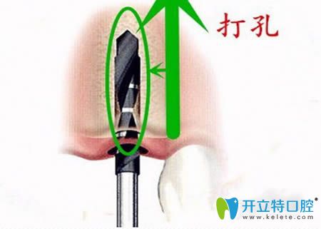 種牙第二步，牙槽骨打孔