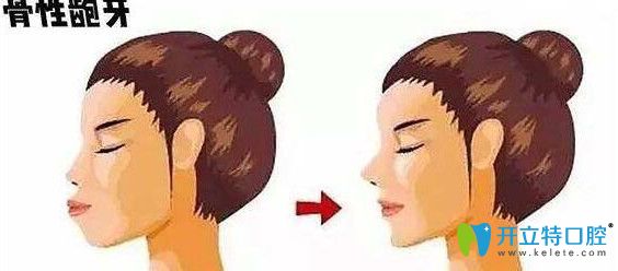 什么是掩飾性正畸及其危害，你了解嗎？