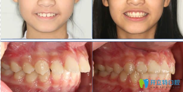 瞅瞅牙齒畸形的顧客在麗江錦美口腔做的牙齒矯正怎么樣吧