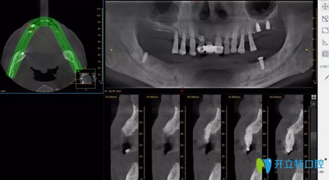 62歲陳叔在深圳諾德口腔體驗(yàn)水激光種植牙真實(shí)經(jīng)歷公布