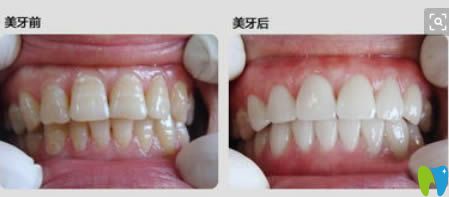 輕度氟斑牙選擇冷光美白后的對比效果