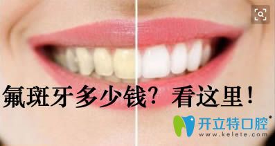 治療氟斑牙的價格需要多少錢