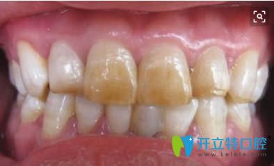 中度氟斑牙圖片