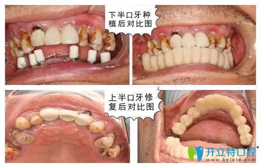 深圳諾德齒科水激光種牙后對(duì)比圖