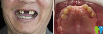 種植牙真實(shí)案例見證重慶齊美口腔到底好不好？