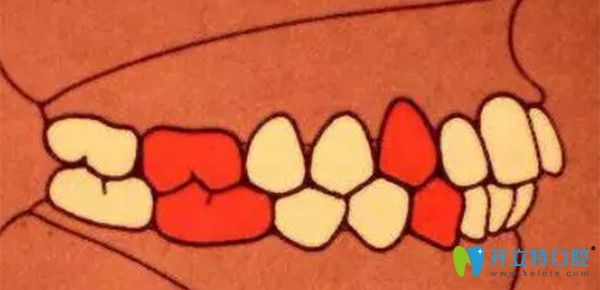 安氏一類錯(cuò)頜   中性錯(cuò)頜