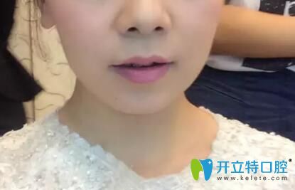 掩飾性正畸后正頜成功經(jīng)驗分享