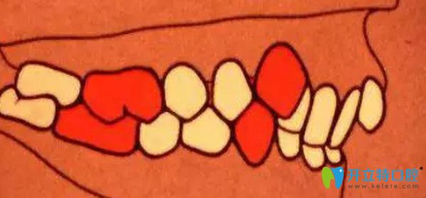 安氏二類錯(cuò)頜  遠(yuǎn)中錯(cuò)頜  第2分類