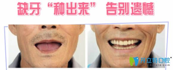 <!--<i data=20240703-sp></i>-->口腔科全口種植牙齒案例圖