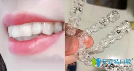 我在安徽維多利亞口腔做隱適美正畸中牙齒和牙套照