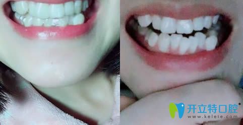 我在安徽維多利亞口腔做正畸前的牙齒照