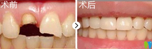 牙齒美容修復(fù)前后對(duì)比圖 牙齒美容修復(fù)前后對(duì)比圖
