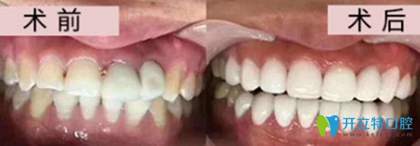 牙齒美學(xué)修復(fù)效果圖 牙齒美學(xué)修復(fù)效果圖