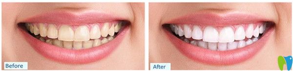 皓齒美白效果展示圖 皓齒美白效果展示圖