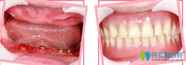 全口種植牙前后對比照 全口種植牙前后對比照