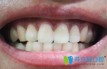 談對刃頜的危害及對刃頜牙齒怎么矯正