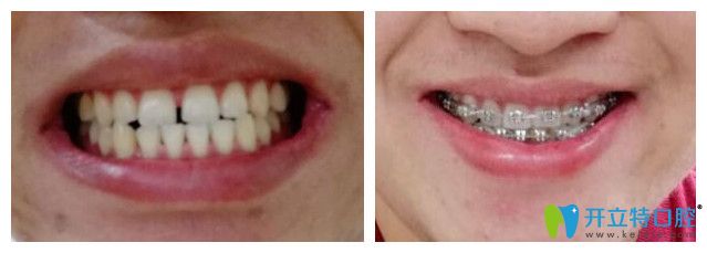對刃頜金屬托槽矯正前后對比圖