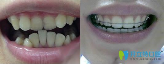 牙齒矯正后會容易早掉嗎