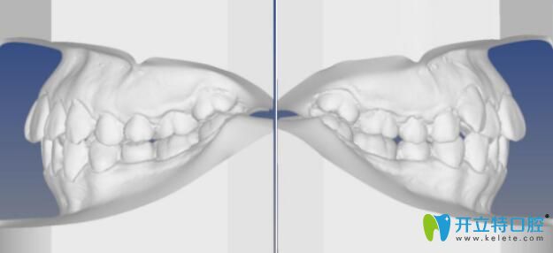 博思美隱形矯正效果好不好