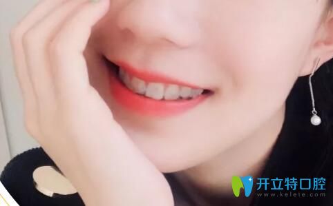 邯鄲連保強口腔牙齒矯正效果圖