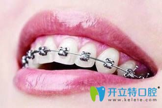 矯正牙齒老了會容易掉嗎