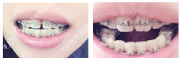 牙齒稀疏不齊在廣州壹加壹矯正四個月，變化大嗎