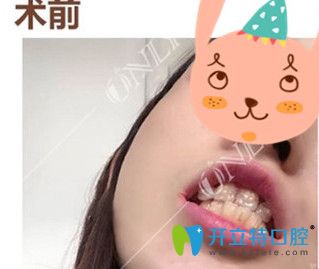 廣州壹加壹口腔 我在廣州壹加壹矯正前牙反頜120天 牙齒整齊了下巴也出來了