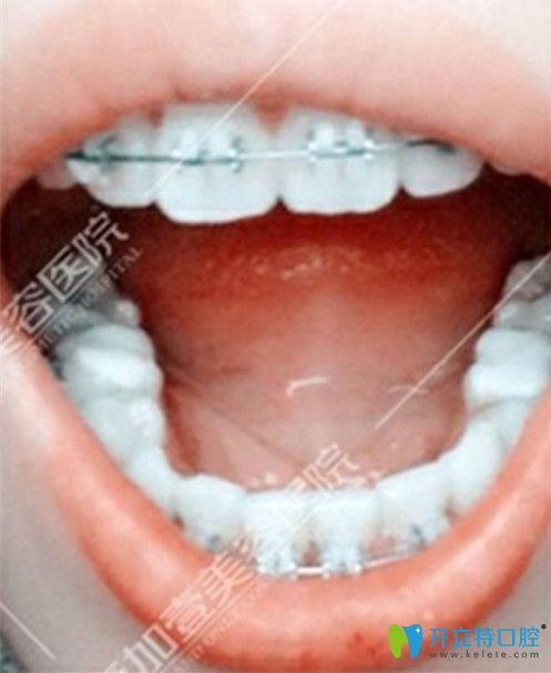 牙齒稀疏矯正前后效果