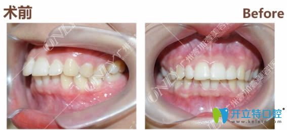 廣州壹加壹口腔成功摘牙套!我花2萬多讓廣州壹加壹的蘇文新做了深覆蓋矯正