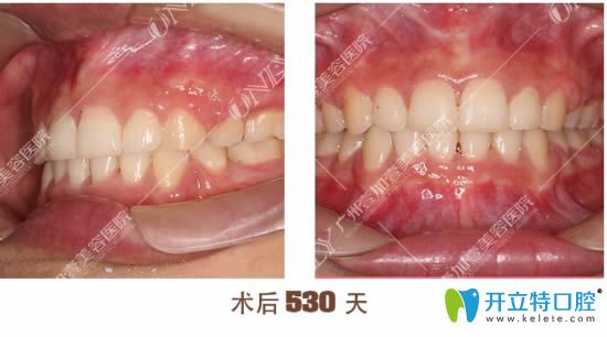在廣州壹加壹牙科摘掉金屬牙套后的效果
