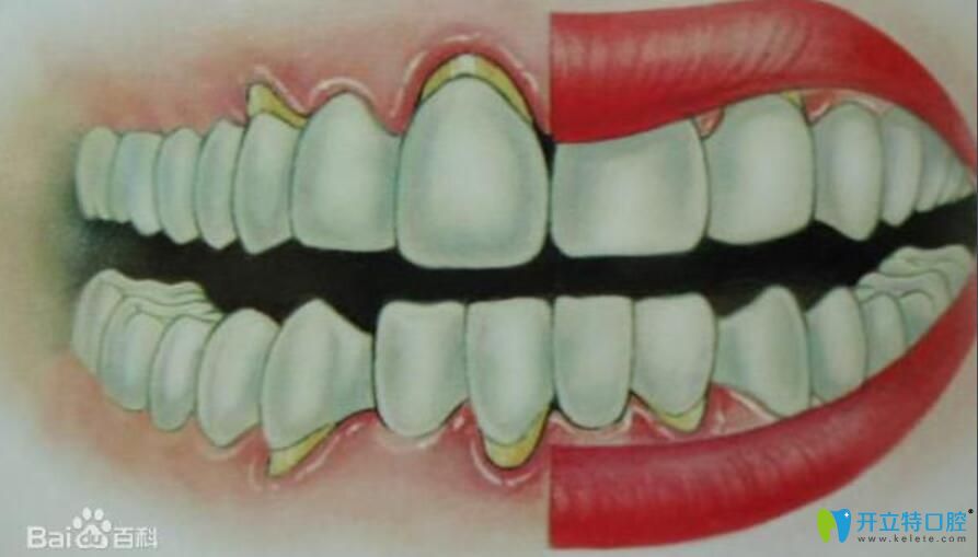 牙槽骨萎縮假牙掛不住，請問牙槽骨萎縮還能恢復嗎？